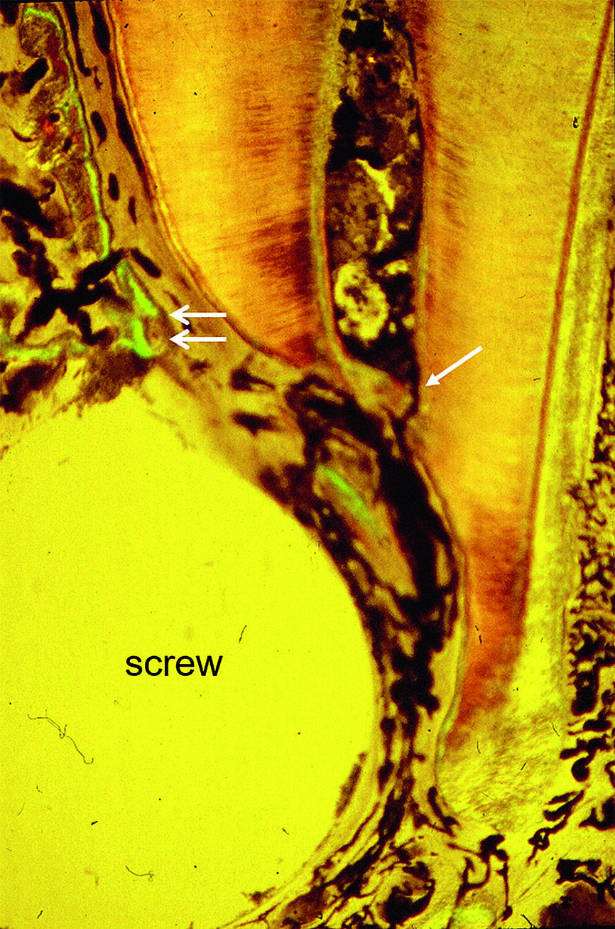 Fig. 11 : Échantillon histologique de tissu dur non décalcifié. L’es pace entre la vis et l’apex radiculaire est complètement rempli de tissu conjonctif et a l’apparence d’un nouveau desmodonte