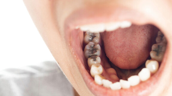 Amalgam versus composite: UK study warns of care crisis over 2034 phase-out