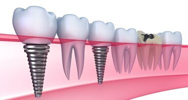 KiMo stelt eerste klinische richtlijn vast: peri-implantaire infecties