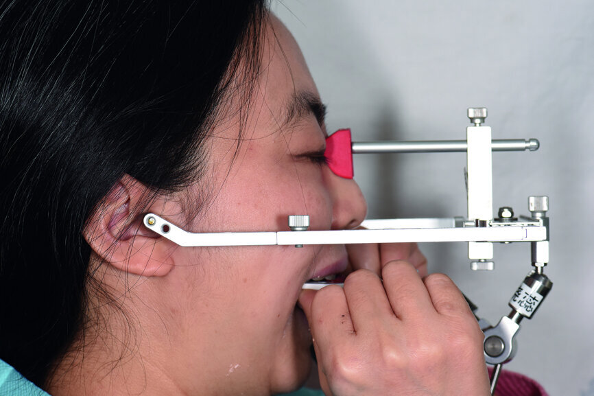 Fig. 24: Facebow transfer of the provisional restoration.