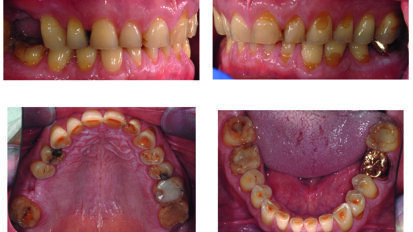 Case report: protesi adesiva di paziente con grave usura dentale. Follow-up a 4 anni