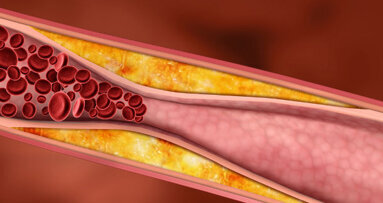 Dental plaque bacteria may trigger endocarditis
