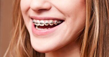Orthodontische behandeling leidt niet tot meer zelfvertrouwen