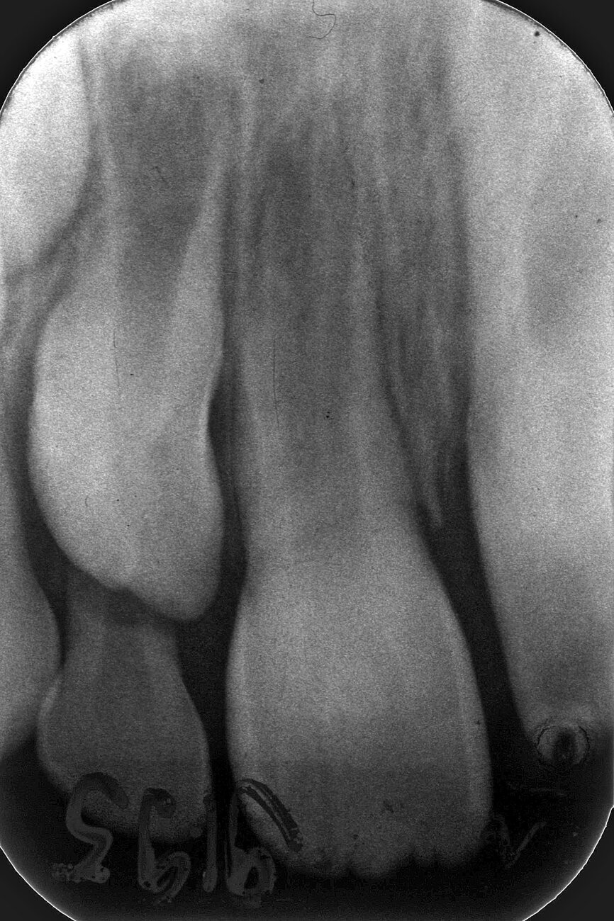 Case 3: Female (born 8 August 1988): Tooth 11
Fig. 5a: 4 September 1995 ante RCF
(non-vital).