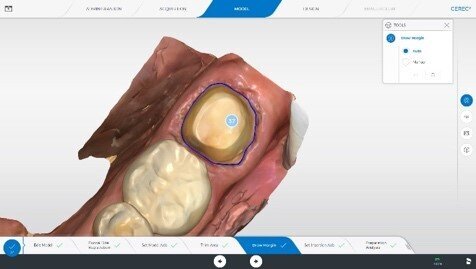 The preparation margin is automatically delineated by the software, but, if desired, it can also be adjusted manually