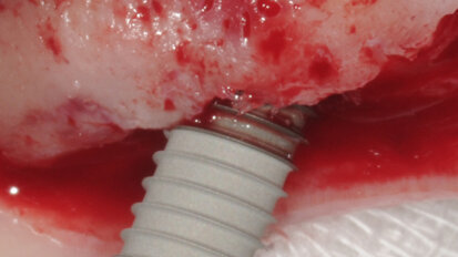 Nuove possibilità per la riabilitazione dei mascellari con estesa pneumatizzazione dei seni mascellari