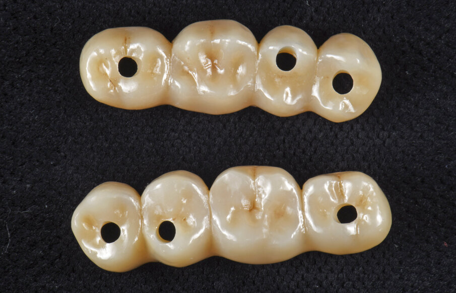 Obr. 13–18: Konstrukce Atlantis BridgeBase, zirkonové můstky a finální náhrady.