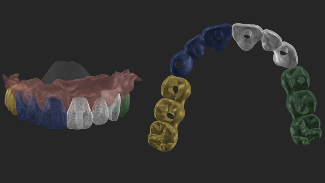 Fig. 32: Splitting the definitive restoration.
