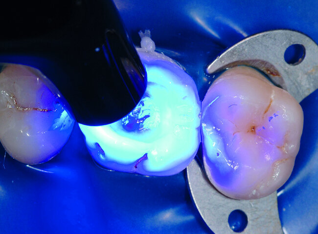 Fig. 21: L’adhésif est polymérisé