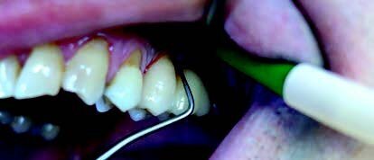 Fig. 8: Probing the pocket