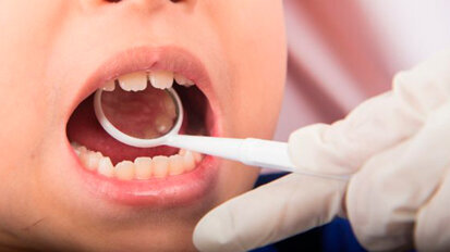 Rilevati alti livelli di mercurio nelle urine nei bambini con otturazioni in amalgama