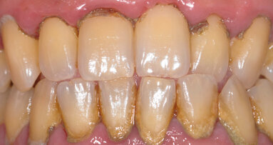 Nuovo approccio al protocollo di full-mouth disinfection