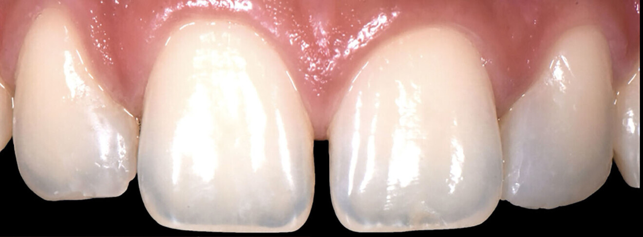 Figs. 2a–d: Choice of shade values.