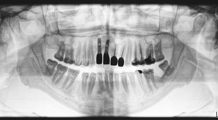 Figure 18: OPG showing the final cemented restorations no 7 and 8. 