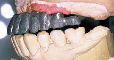 Full-Arch Implant-Retained-Restoration. Fixed or Removable?