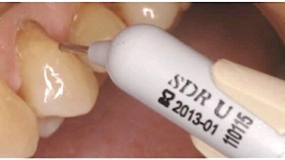 El manejo de la sensibilidad antes, durante y después del tratamiento de aclaramiento dental