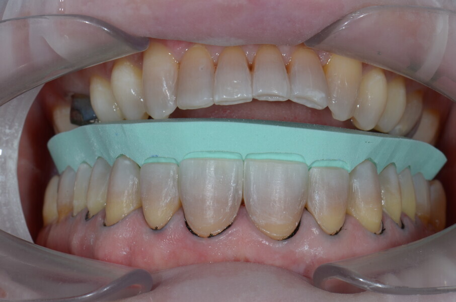 Fig. 7: Sectioned silicone index to check the incisal spaces.