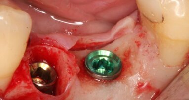 Verticale reconstructie van peri-implantaire zachte weefsels