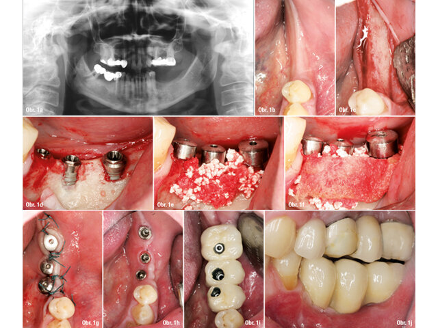 Pacient s dehiscencí ošetřený pomocí GBR s nezanořeným postupem: a) Předoperační panoramatický rentgenový snímek, b) Předoperační pohled na okluzi, c) Atrofie kosti alveolárního hřebene vizualizovaná po odklopení laloku, d) Zavedení implantátů do oblasti 35, 36 a 37, e) Syntetická kost překrývající dehiscenci, f) Resorbovatelná membrána aplikovaná přes kostní náhradu, g) Sutury, h) Zhojené měkké tkáně, i) Okluzální pohled na umístěnou protetickou práci, j) Laterální pohled na protetickou práci