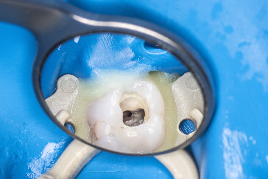 Fig. 42: The orifice of the MB2 canal and the cleaned isthmus, seen in the orifice of the MB1 canal.