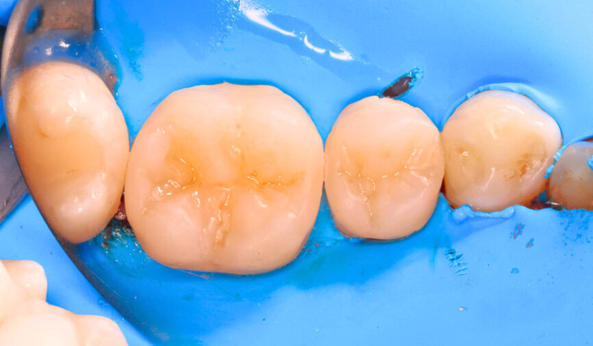 Fig. 6: The particles are once again spread over the entire restoration surface, and the finer the particle, the better the polishing effect in the grooves.
