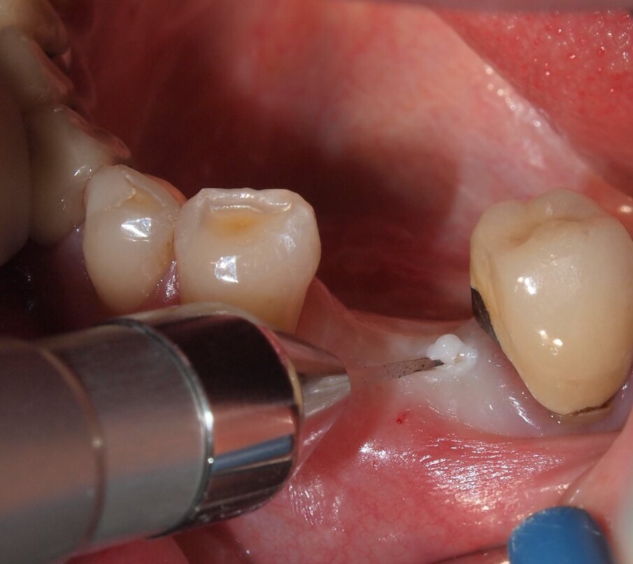 Fig. 3 - Caso clinico 1. Incisione dei tessuti molli con laser a diodi da 915 nm ed inserto in zaffiro. Si osservi l’annerimento della porzione terminale dell’inserto, ad indicarne l’avvenuta attivazione.