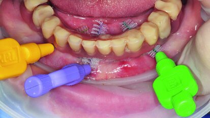 Prevention 0: The best way to prevent peri-implant disease? Prevention 0: The best way to prevent peri-implant disease?