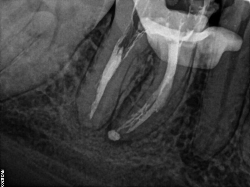 Fig. 23: Post-op radiograph. Puff of the sealer visible.
