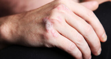 Smoking as a permissive factor of periodontal disease in psoriasis