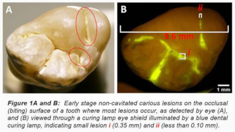 GreenMark to develop technology for early caries detection