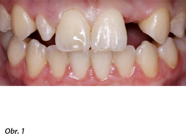 Obr. 1, 2: Horní zuby pacientky před ošetřením.