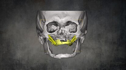 Precise implantation using zygomatic implants with Le Fort I osteotomy