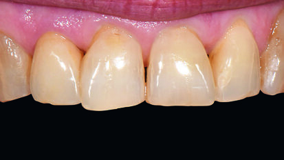 Precisely controlling shade saturation with VITA AKZENT Plus CHROMA STAINS