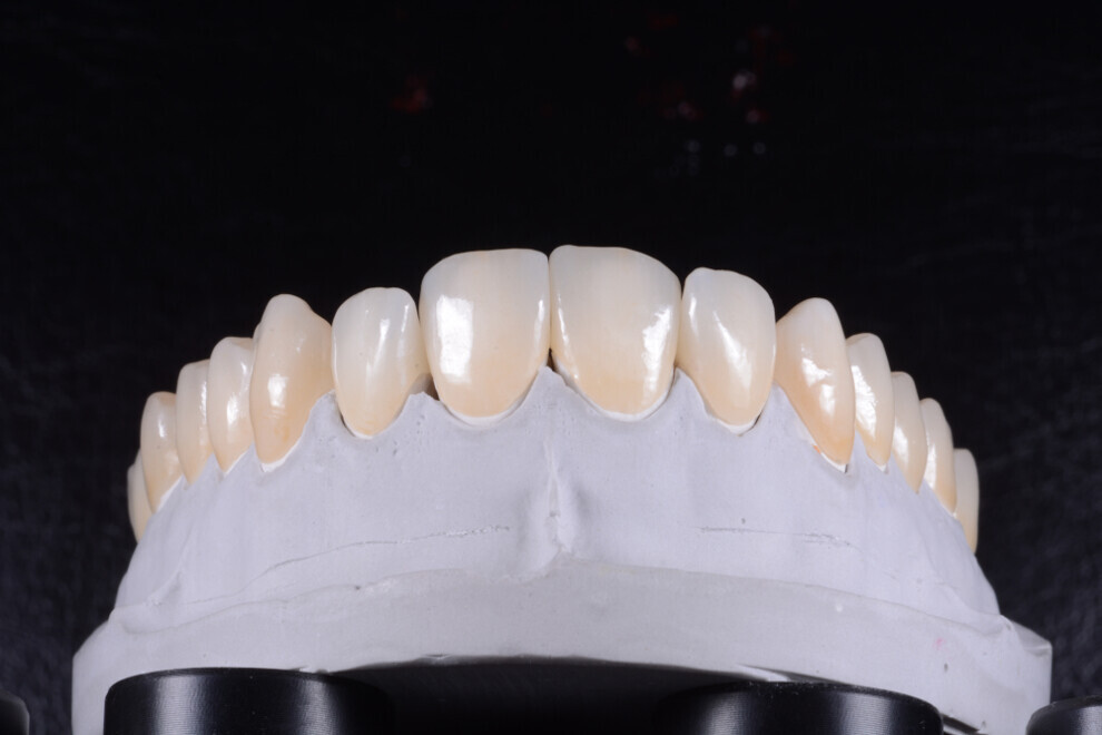 Beautiful, precisely fitting ceramic restorations produced at DentLab. 