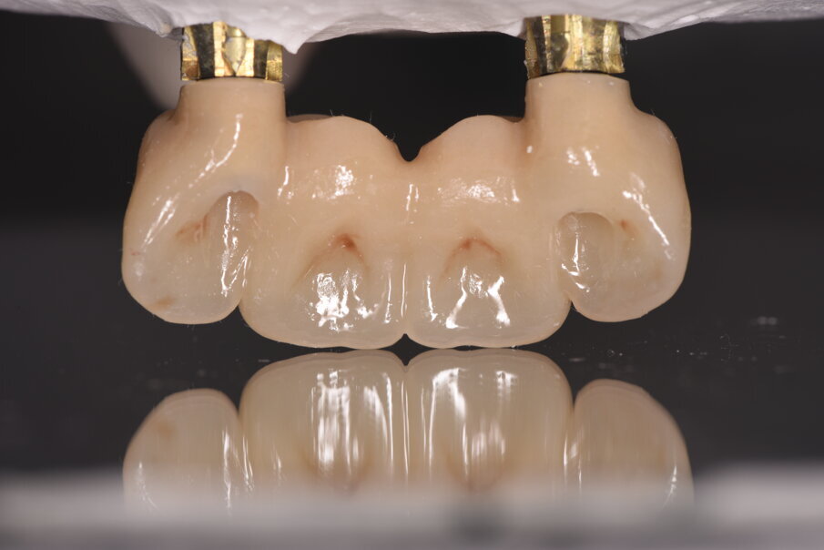 Fig. 28_Visione palatale con l’emergenza dei fori per l’avvitamento delle corone.