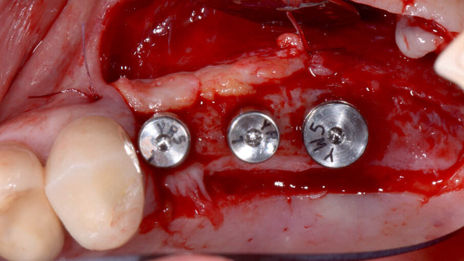 Obr. 16: Štěp pojivových tkání přišitý k periosteu s nasazenými vhojovacími válečky.