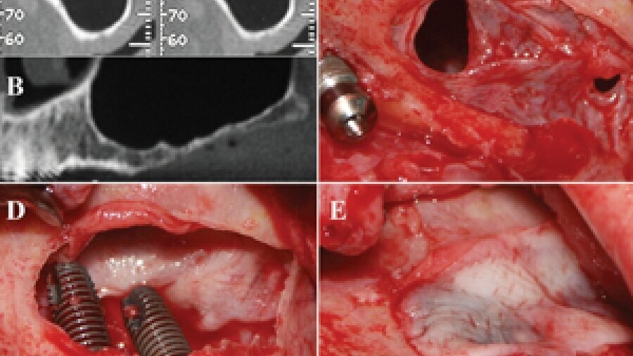 PRF brings new challenges to the dental office