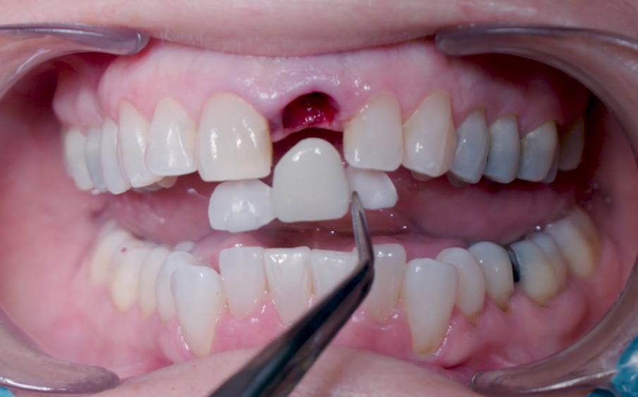 Figg. 22, 23_Valutazione dell’adeguatezza del guscio provvisorio. 