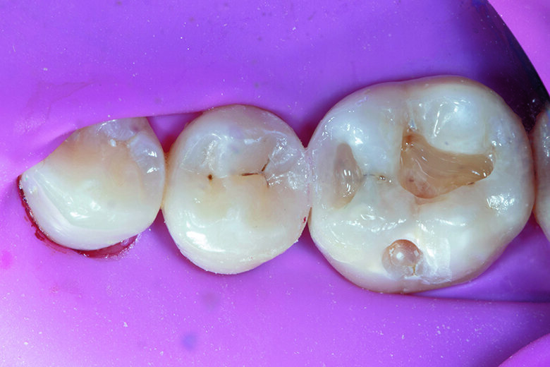 Fig. 8. Composite build-up with  a combination of Beautifil Injectable XSL and Beautifil II LS, leaving 1.5 mm. 