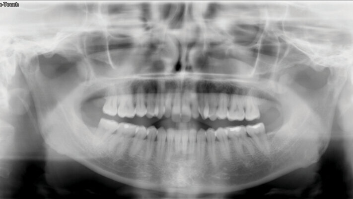 Řešení otevřeného skusu u dospělého pomocí Insignia™ systému a Straight-Wire™ finishingu