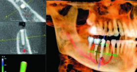 CBCT—种植选择的清晰透视