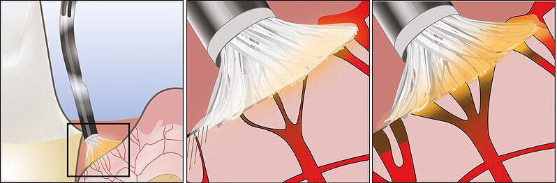 Fig 3. Metal Dento-Infusor tip delivering the hemostatic agent right at the orifices of the bleeding capillaries. Constant application of the hemostatic agent with the pressure and brushing movement, creates the coagulum that closes the capillary orifices. 