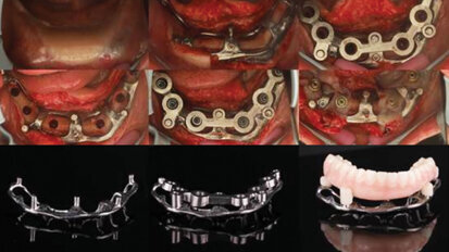 Drs. Cory Glenn and Danny Domingue now offering in-person courses on full-arch surgical guide design