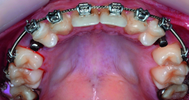 Orthodontic management of maxillary lateral incisors agenesis