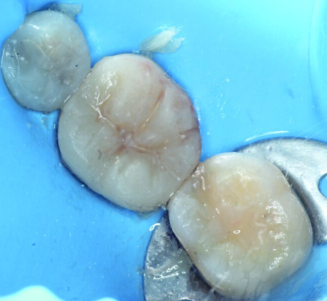 Fig. 15b: Light polymerisation after removal of the excess luting material.