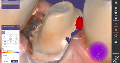 DentalCAD 3.2 enhances precision with new tool for repairing preparation margins
