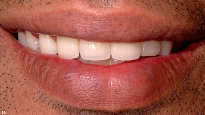 Functional reconstruction and aesthetic management of the anterior maxillary segment