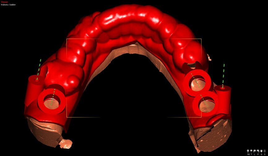 Ryc. 1a_Wirtualne planowanie położenia wszczepów.