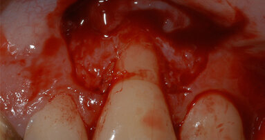 Riabilitazione protesica in area ad alta valenza estetica tra  tecniche tradizionali e digitali