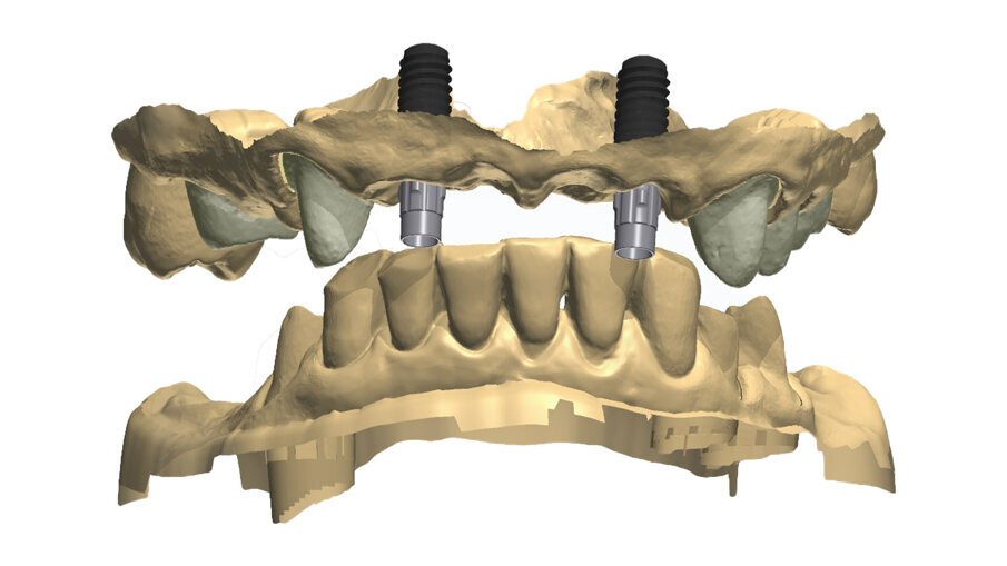 Fig. 32_Posizione centrica delle arcate senza provvisori.